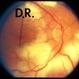Progressive Outer Retinal Necrosis